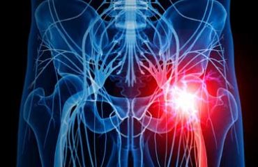 Sciatica_comp